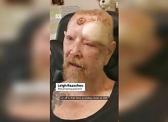 Il avertit sur les dangers du soleil après 200 cancers de la peau