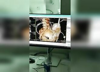 Elle va à l'hôpital pour des calculs vésicaux, on découvre un bébé calcifié en elle