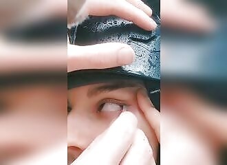 She has a leech removed from her eye