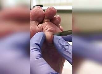 It was time to empty that cyst!